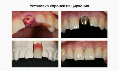 Замена старой металлокерамики на коронки из оксида циркония