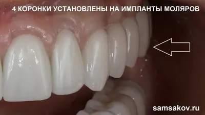 Цена на циркониевые зубные коронки в Ульяновске