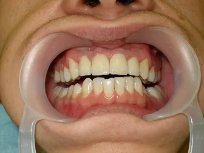 Коронки из циркония, 22, 12 зубы | Примеры работ - фото до и после