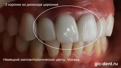 ᐉ Коронки из диоксида циркония | Стоматология «Бланко» Днепр