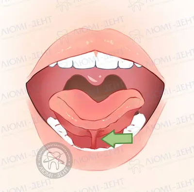 Пластика уздечки языка в Уфе | Стоматологическая клиника «Маэстро»