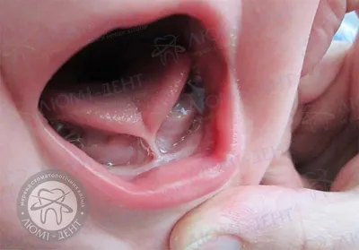 Пластика короткой уздечки языка, верхней и нижней губ у ребенка