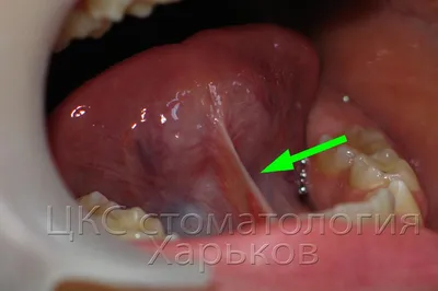 Подрезание уздечки языка лазером - «Не затягивайте с проведением этой  процедуры» | отзывы