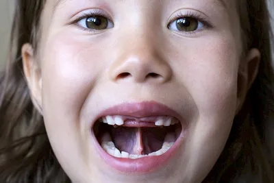 Короткая уздечка языка у ребенка — нужно ли подрезать уздечку и в каком  возрасте