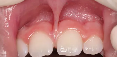 Пластика уздечки зуба. Подрезание короткой уздечки в стоматологии Лекта  Мытищи