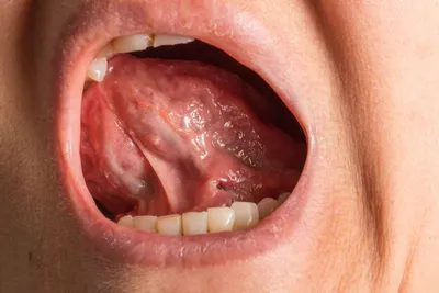 Коррекция (пластика) уздечки верхней и нижней губы у детей в СПб -  стоматология ИНТАН