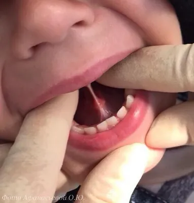 Пластика уздечки верхней губы и языка лазером у детей