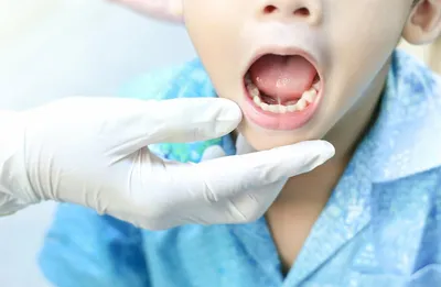 Пластика уздечки губы и языка - Стоматология