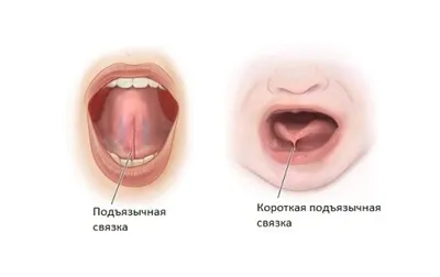 Уздечка языка: показания к операции