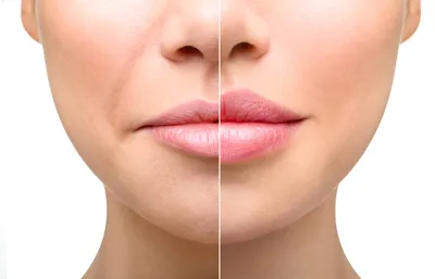 ᐉ Контурная пластика губ Запорожье ⭐ Косметологическая Клиника BeautyMED