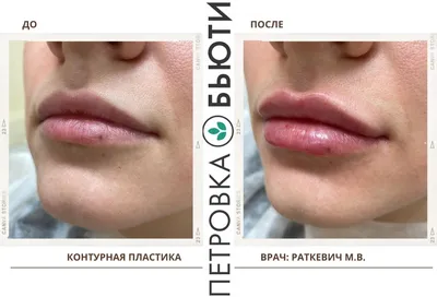 Dr_Xasan - 🤍Здравствуйте дорогие мои ответ на вопрос как происходить  увеличения губ 💉 👄Увеличение губ или коррекция их формы может проводиться  несколькими методами контурной пластики. В своём большинстве это препараты  гелевой консистенции