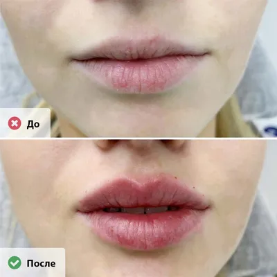 Как увеличить губы - какой филлер из гилауроновой кислоты для губ лучше -  отзывы, фото до и после