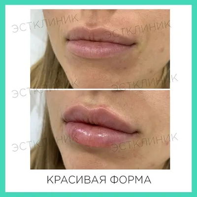 Увеличение и коррекция формы губ гиалуроновой кислотой в Jolly Clinic