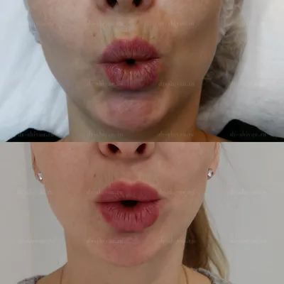 Уменьшение губ после увеличения | filler.by
