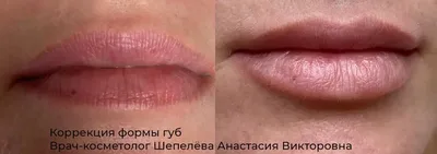 Увеличение губ, контурная пластика губ – салон красоты Fleur г. Луганск