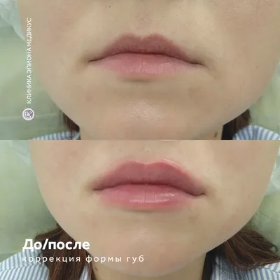 Коррекция формы губ. | Клиника косметологии GEN 87 в Москве | Цены, фото до  и после на сайте.