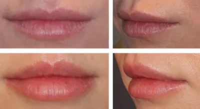 Увеличение и коррекция губ губки бантиком | Doctor, Photo and video,  Instagram photo