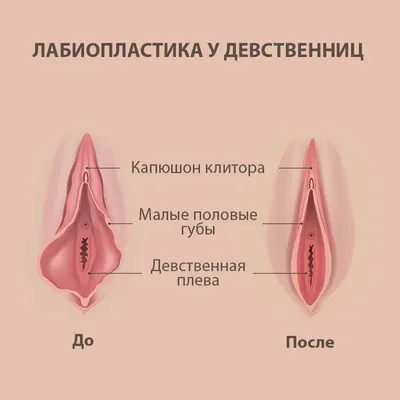 Лабиопластика малых половых губ в Минске: цены на интимную пластику