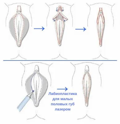 Интимная контурная пластика филлерами в Минске, цена