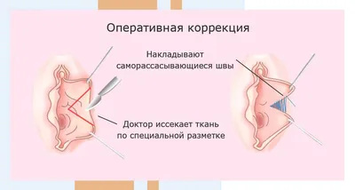Лабиопластика - цена в Нижнем Новгороде