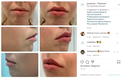 Лабиопластика это операция по коррекции визуальной формы и размера малых половых  губ. Операция проводится как с целью эстетической… | Instagram