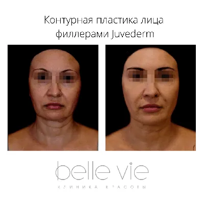 Инъекционная косметология в Ижевске - контурная пластика