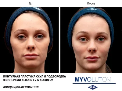 Контурная пластика лица филлерами: цена от 8990 руб/мл в Москве | Cделать  контурную пластику в клинике BeautyWay Clinic