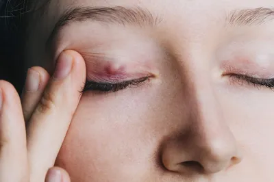 Халязион на глазу — причины, симптомы, лечение
