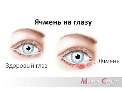 Заболевания кожи вокруг глаз и воспаление век. Диагностика и лечение
