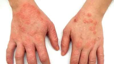 Кожные заболевания рук фото: симптомы, лечение, причины