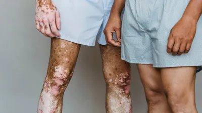 Псориаз, дерматит и другие кожные заболевания: как вылечить и сохранить  здоровье кожи