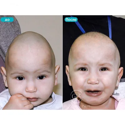 Краниостеноз фото до и после операции фотографии
