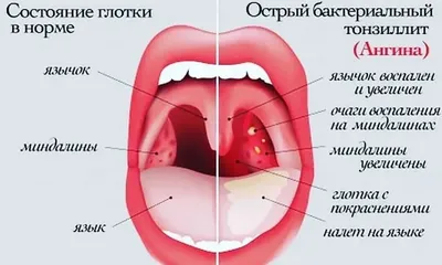 Причины появления красного горла без болевых ощущений