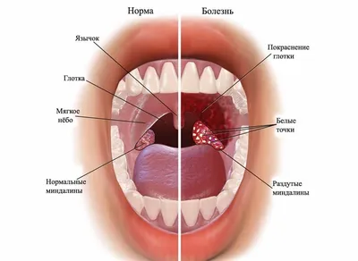 Как выглядит горло человека: отличия здорового и больного