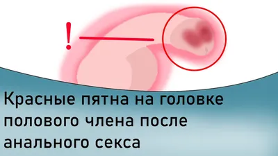 Красное пятно на головке пениса: возможные причины и методы лечения