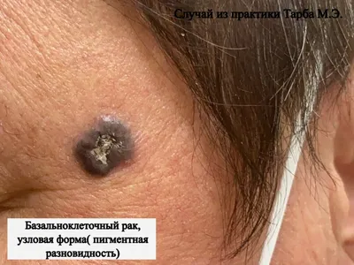 Ответы Mail.ru: Красное пятно на коже головы