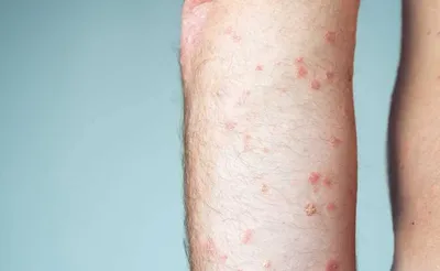Причины появления красных пятен на коже при различных заболеваниях