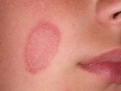 Красные пятна на коже у взрослых и детей - виды высыпаний и их фото,  аллергия с зудом и без
