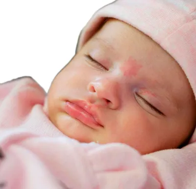 Поцелуй ангела и укус аиста: лососевые пятна у новорожденных | МЦ Лазерсвiт