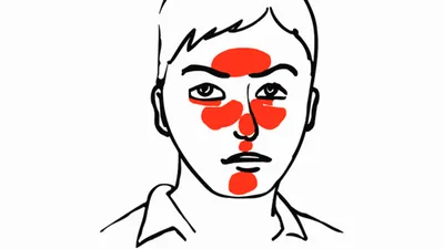 Розацеа на лице: лечение, причины, симптомы