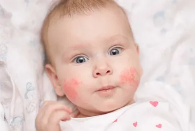 Красное пятно на коже у ребенка: причины и способы лечения