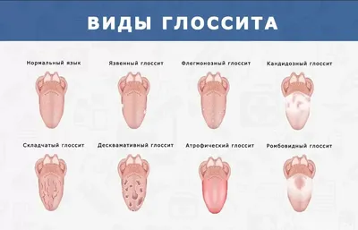 Сыпь На Корне Языка Прыщи Ближе к Горлу ЛюмиДент