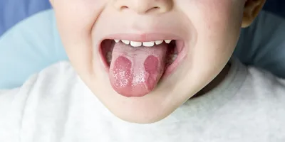 Покраснения на языке и нёбе точки красные - Стоматология - Форум  стоматологов (стомотологический форум) - Профессиональный стоматологический  портал (сайт) «Клуб стоматологов»