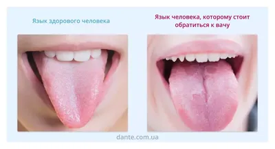 Красные пятна на языке #спб #пятнанаязыке #стоматологияспб | TikTok