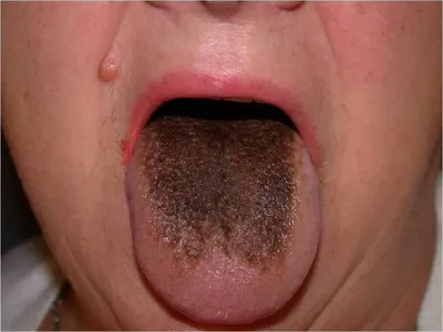 Красные пятна на языке: симптомы и лечение глоссита — ROOTT