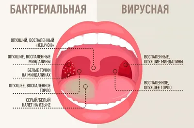 Симптомы болезни языка