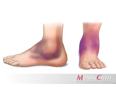 Атеросклероз нижних конечностей – облитерирующий и хронический - причина  онемения ног.