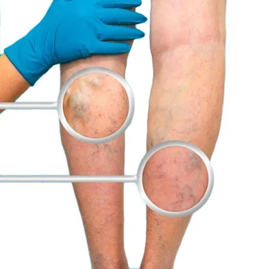 Цианоз нижних конечностей: почему синеют ноги? | МЦ «Институт Вен»
