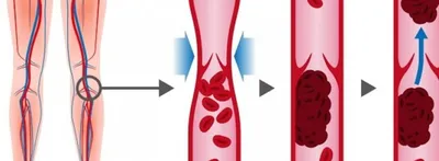 Нужно ли разжижать кровь при варикозе и тромбофлебите? - «Институт Вен»  лечение варикоза в Киеве и Харькове