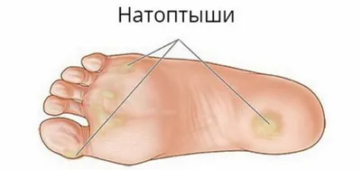 Подногтевая гематома - причины, симптомы, диагностика, лечение и  профилактика